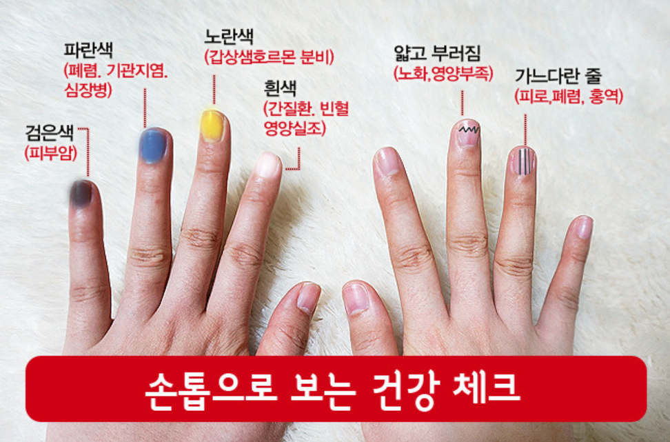 손톱 색깔에 따른 건강 체크