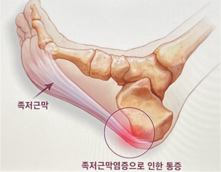 족적근막염이란