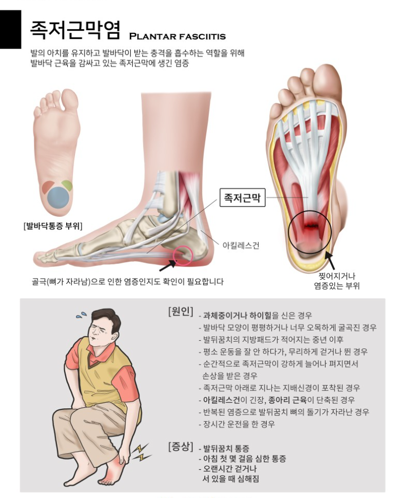 족적근만역 원인